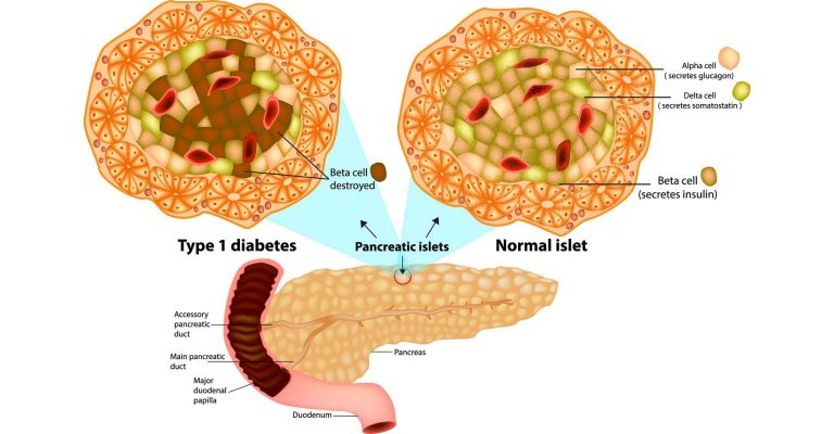 A Novel Approach to Type 1 Diabetes Treatment