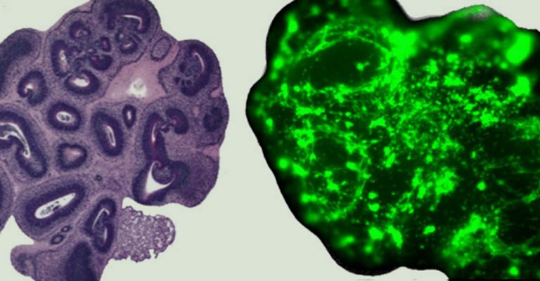 An image of the 'normal' and 'glioma' cerebral organoids Image © finelab.weill.cornell.edu