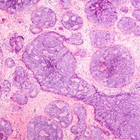 Breast Cancer Microenvironment