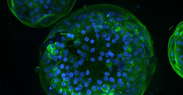 Precision Medicine Advancements: The Role of 3D Cell Culture